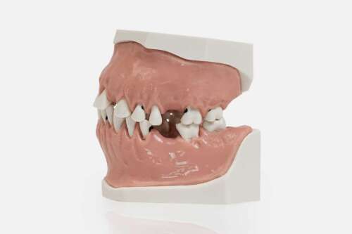 Модель верхней и нижней челюсти с патологией тканей пародонта на разных стадиях заболевания